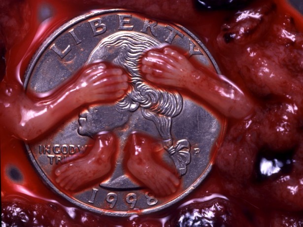 Image of arms and legs torn off a baby aborted at 9 weeks.