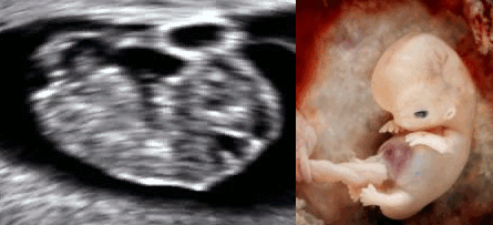 Low resolution gif of an ultrasound of a baby moving at 9 weeks of gestation next to an ectopic pregnancy baby of the same age